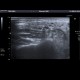 Sjogren syndrom, sialolithiasis, parotid gland: US - Ultrasound